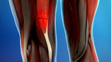 Lesion de Isquiotibiales 