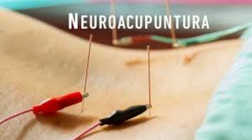 Neuroacupuntura