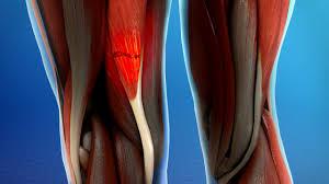 Lesion de Isquiotibiales 