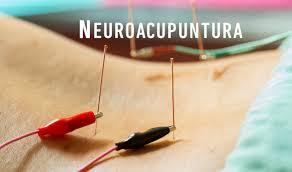 Neuroacupuntura