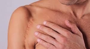 Cicatriz Muscular